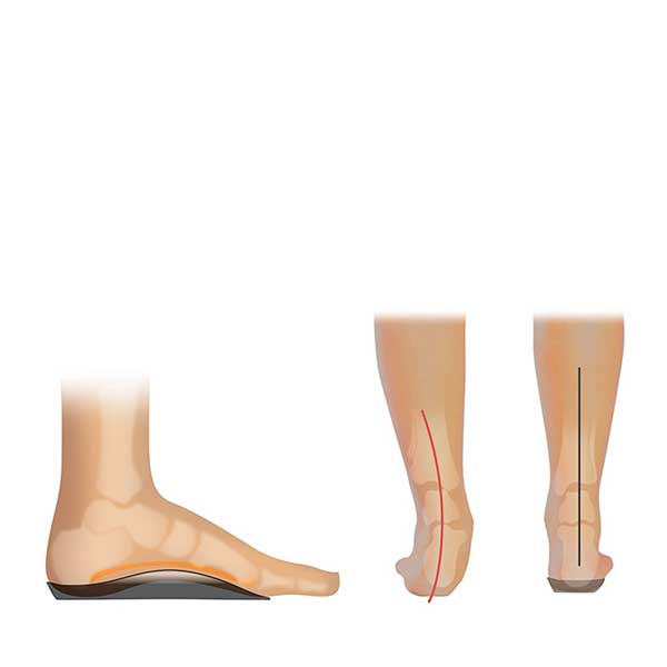 Footlogics CASUAL Orthotics